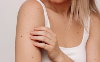 Frau betrachtet die Haut an ihrem Oberarm mit vielen kleinen Muttermalen.