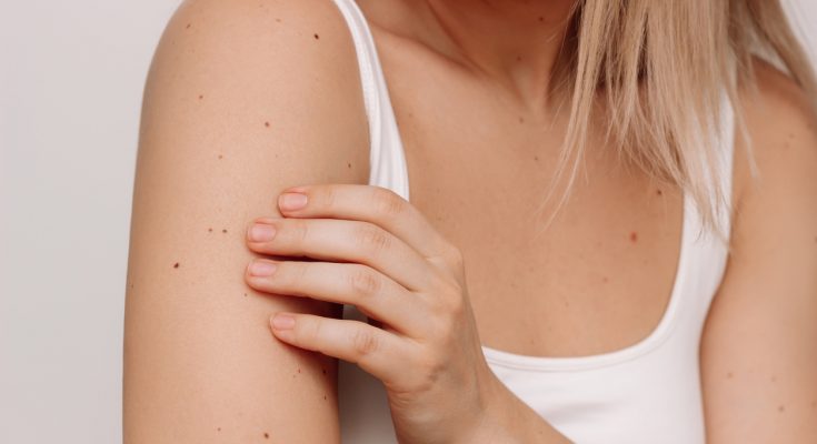 Frau betrachtet die Haut an ihrem Oberarm mit vielen kleinen Muttermalen.