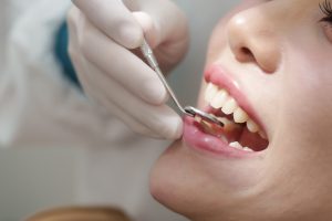 Nahaufnahme eines geöffneten Mundes bei der Zahnkontrolle mit Dentalspiegel.