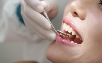 Nahaufnahme eines geöffneten Mundes bei der Zahnkontrolle mit Dentalspiegel.