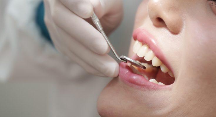 Nahaufnahme eines geöffneten Mundes bei der Zahnkontrolle mit Dentalspiegel.