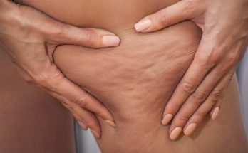 Frau kneift Haut am Oberschenkel zusammen, sodass Dellen des Bindegewebes sichtbar werden.